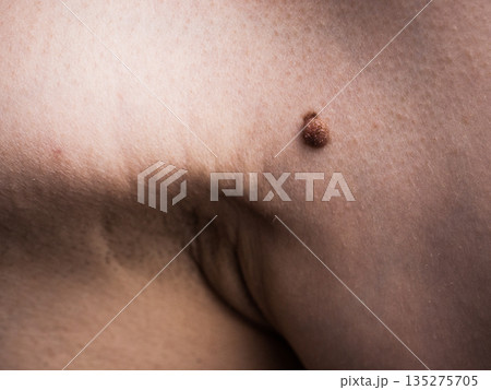 Dark fibroma, dermatology problem on skin. Close up of papilloma dermatosis Dark fibroma, dermatology problem on skin. Close up of papilloma dermatosis 135275705