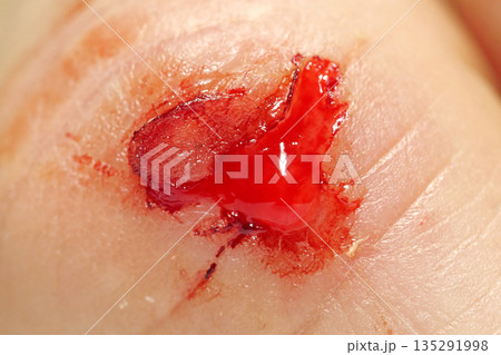 Injury of middle finger of right hand with bleeding. Flayed skin,blood and lymph Injury of middle finger of right hand with bleeding. Flayed skin,blood and lymph 135291998