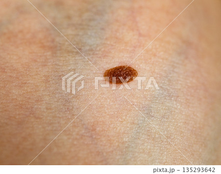 Closeup brown mole on skin. 135293642