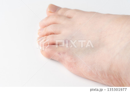 打撲した足の小指のクローズアップ 135301977
