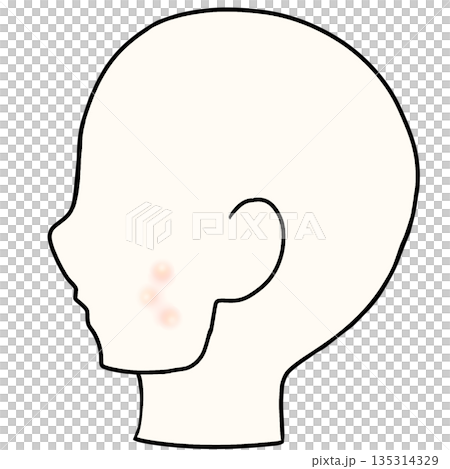 臉頰痤瘡皮膚症狀 135314329