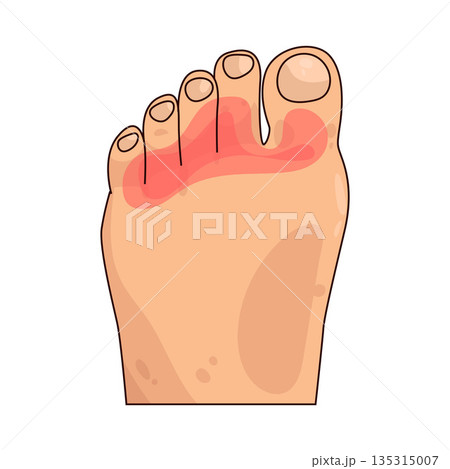 illustration of Toe Pain 135315007