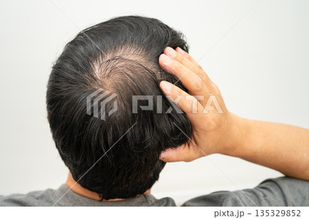 Bald in the middle head and begin no loss hair glabrous of mature man. Bald in the middle head and begin no loss hair glabrous of mature man. 135329852