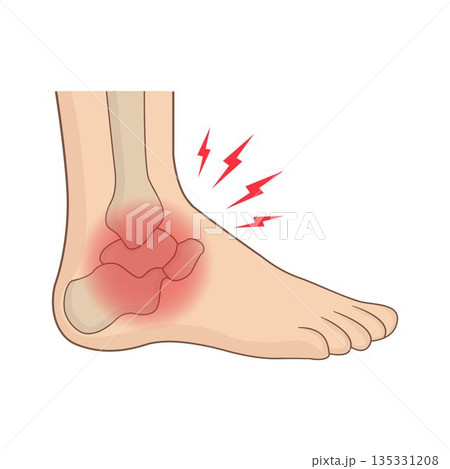 Medical anatomical illustration of a human foot with red inflamed ankle joint 135331208