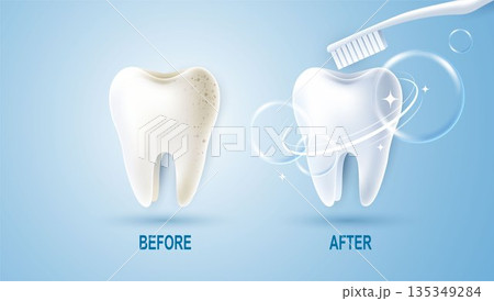 Set of dental cleaning and whitening teeth concept. comparison of clean and dirty tooth. dental health and oral hygiene poster for dentistry. examination teeth, whitening and repair. vector design. Set of dental cleaning and whitening teeth concept. comparison of clean and dirty tooth. dental health and oral hygiene poster for dentistry. examination teeth, whitening and repair. vector design. 135349284