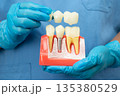 Asian dentist holding dental implant, artificial tooth roots into jaw, root canal of dental treatment, gum disease, teeth model for dentist. 135380529