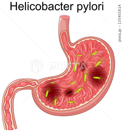 Helicobacter pylori Bacteria in Human Stomach Vector Illustration 135401614