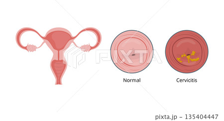 Cervicitis, inflammation of the cervix, and normal cervix comparison 135404447