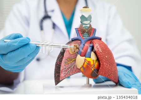 Pneumonia, lung cancer, Asian doctor holding human model. 135434018