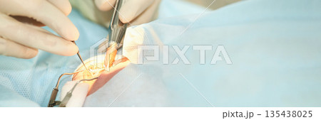 Close-up of surgical procedure on eye with medical instruments and sterile Close-up of surgical procedure on eye with medical instruments and sterile 135438025