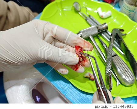 Close-up Extraction Tooth with Dental Instruments in Oral Surgery Setup 135449933