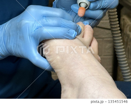 Hardware medical pedicure using a drill and nail files. A patient has a pedicure at a podiatrist. A dangerous fungal lesion of human toenails. Onychomycosis, treatment of nail fungus. Hardware medical pedicure using a drill and nail files. A patient has a pedicure at a podiatrist. A dangerous fungal lesion of human toenails. Onychomycosis, treatment of nail fungus. 135451546