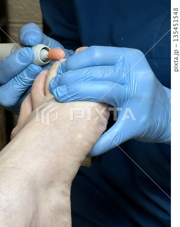 Hardware medical pedicure using a drill and nail files. A patient has a pedicure at a podiatrist. A dangerous fungal lesion of human toenails. Onychomycosis, treatment of nail fungus. Hardware medical pedicure using a drill and nail files. A patient has a pedicure at a podiatrist. A dangerous fungal lesion of human toenails. Onychomycosis, treatment of nail fungus. 135451548