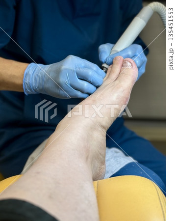 Hardware medical pedicure using a drill and nail files. A patient has a pedicure at a podiatrist. A dangerous fungal lesion of human toenails. Onychomycosis, treatment of nail fungus. Hardware medical pedicure using a drill and nail files. A patient has a pedicure at a podiatrist. A dangerous fungal lesion of human toenails. Onychomycosis, treatment of nail fungus. 135451553
