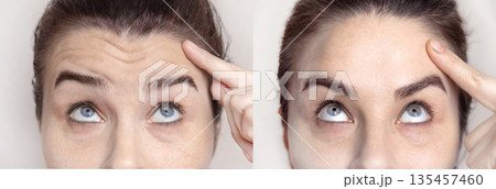 Collage with portraits Caucasian woman with wrinkles on the forehead and between her nose and portrait after visiting a beautician. Botox injections, dysport. Folds on the skin. Close up photo 135457460