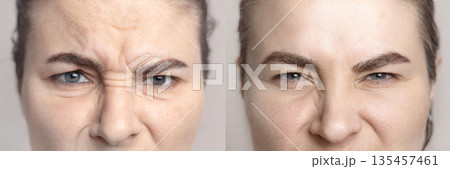 Collage with portraits Caucasian woman with wrinkles on the bridge of her nose and between the eyebrows and portrait after visiting a beautician. Botox injections, dysport. Folds on the skin. Close up 135457461