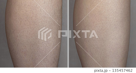 Collage photo before and after hair removal. Image before and after leg hairs removal concept. close up photo macro Collage photo before and after hair removal. Image before and after leg hairs removal concept. close up photo macro 135457462