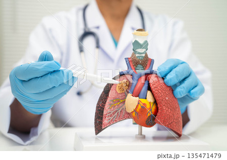 Pneumonia, lung cancer, Asian doctor holding human anatomy model for study diagnosis and treatment in hospital. Pneumonia, lung cancer, Asian doctor holding human anatomy model for study diagnosis and treatment in hospital. 135471479