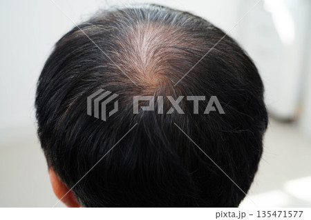 Bald head in man, hair loss treatment health problem. Bald head in man, hair loss treatment health problem. 135471577