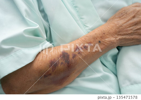 Ecchymosis, elderly bleeding on her arm after taking aspirin. 135471578