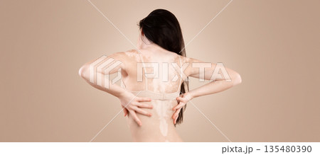 Vitiligo Skin. Rear View Of Young Woman With Body Depigmentation Posing In Underwear Over Beige Background In Studio, Skinny Female With Autoimmune Disorder Holding Hands On Back, Copy Space Vitiligo Skin. Rear View Of Young Woman With Body Depigmentation Posing In Underwear Over Beige Background In Studio, Skinny Female With Autoimmune Disorder Holding Hands On Back, Copy Space 135480390