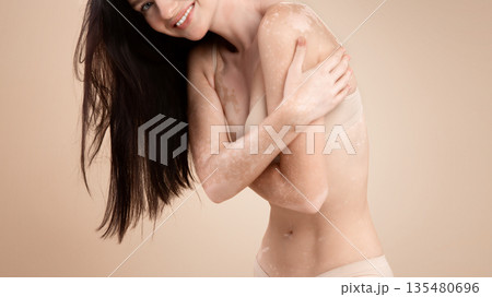 Love Your Body. Portrait Of Skinny Young Lady With Vitiligo Skin Disorder Posing In Underwear On Beige Background In Studio, Cropped Image Of Positive Woman With Skin Depigmentation, Free Space Love Your Body. Portrait Of Skinny Young Lady With Vitiligo Skin Disorder Posing In Underwear On Beige Background In Studio, Cropped Image Of Positive Woman With Skin Depigmentation, Free Space 135480696