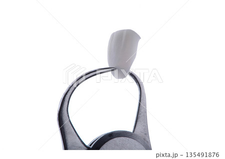 The thickness of a ceramic veneer is measured with a micrometer. Ultra-thin veneer is 0.2 mm thick. 135491876