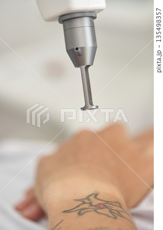 Laser tattoo removal procedure on caucasian male s wrist with star tattoo Laser tattoo removal procedure on caucasian male s wrist with star tattoo 135498357