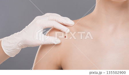 Dermatologist examining birthmark on woman shoulder, closeup. Cancer prevention concept, empty space 135502900