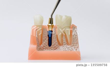 Tool pointing to dental implant abutment in jaw model 135509738