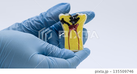 Tooth decay anatomy model held by gloved hands 135509746