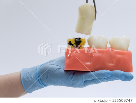 Tooth model with removable crown showing internal decay 135509747