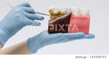 Dental Plaque And Gum Disease Model 135509753