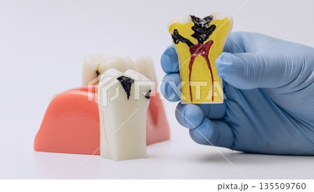 Tooth decay cross-section model showing pulp infection Tooth decay cross-section model showing pulp infection 135509760