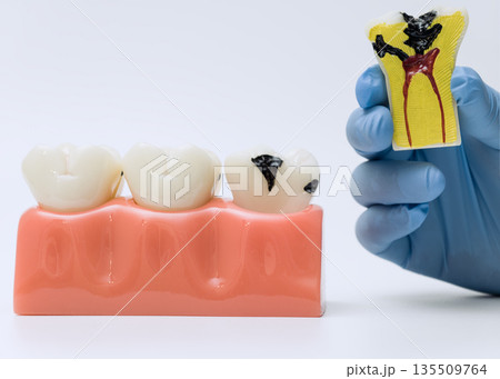 Tooth decay model and pulp infection cross-section Tooth decay model and pulp infection cross-section 135509764