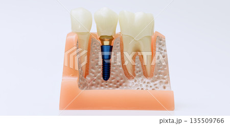 Dental implant model showing tooth and bone integration 135509766