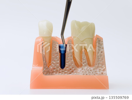 Dental implant model with tool pointing at titanium screw 135509769