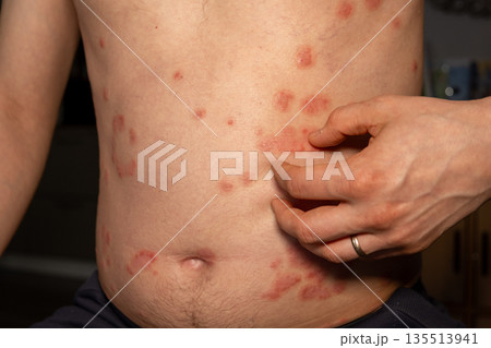 Individual is shown scratching red, itchy patches on the torso, indicative of psoriasis, a chronic skin condition affecting many. 135513941