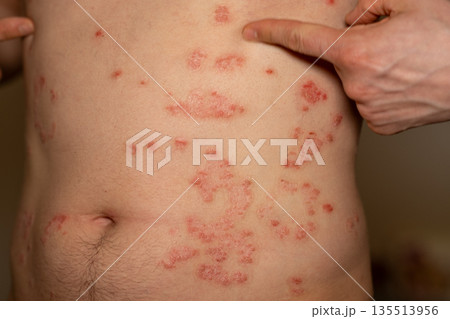 Patches of red, itchy skin appear on the torso, showcasing the common symptoms of psoriasis, an immune related skin condition. 135513956