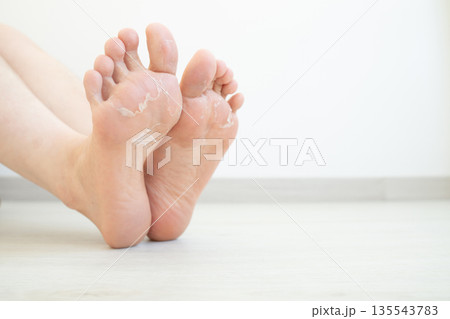 Close up of peeling and cracked foot. Causes of peeling foot included fungal infection (athlete's foot), dermatitis (eczema), sunburn, dry skin, dehydration or sweaty feet. Health care concept. 135543783
