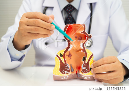Asian doctor with rectum and hemorrhoid human model, inflamed vascular structure. Asian doctor with rectum and hemorrhoid human model, inflamed vascular structure. 135545823