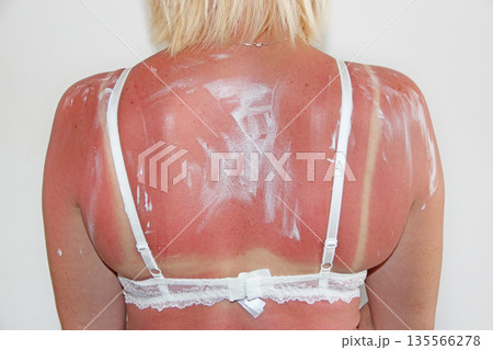 Print of brassiere on female body after beach. Body care 135566278