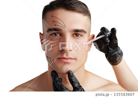 Man receiving facial treatment in a clinic with clear markings on his face for procedure guidance Man receiving facial treatment in a clinic with clear markings on his face for procedure guidance 135583607