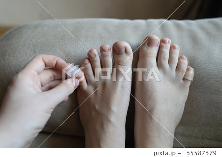 Silicone toe sleeve or cap. Woman puts on protective cover on little toe. Fights corns, prevents blisters and ingrown toenails Silicone toe sleeve or cap. Woman puts on protective cover on little toe. Fights corns, prevents blisters and ingrown toenails 135587379