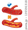 Types of cholesterol in human blood vessels. Normal and narrowed artery for explanation diseases. High-Density Lipoprotein HDL and Low-Density Lipoprotein LDL. Vector illustration 135591318