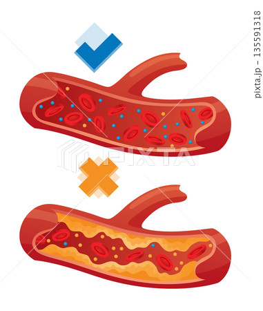 Types of cholesterol in human blood vessels. Normal and narrowed artery for explanation diseases. High-Density Lipoprotein HDL and Low-Density Lipoprotein LDL. Vector illustration Types of cholesterol in human blood vessels. Normal and narrowed artery for explanation diseases. High-Density Lipoprotein HDL and Low-Density Lipoprotein LDL. Vector illustration 135591318