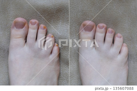 Close-up of damaged human nails showing discoloration, thickening, and separation. Concept of onycholysis, onychomycosis, hyperkeratosis, nail fungus, chromonychia, fungal infection 135607088