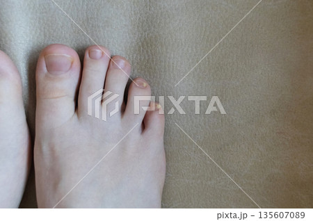 Close-up of damaged human nails showing discoloration, thickening, and separation. Concept of onycholysis, onychomycosis, hyperkeratosis, nail fungus, chromonychia, fungal infection 135607089