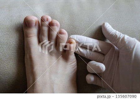 Close-up of damaged human nails showing discoloration, thickening, and separation. Concept of onycholysis, onychomycosis, hyperkeratosis, nail fungus, chromonychia, fungal infection Close-up of damaged human nails showing discoloration, thickening, and separation. Concept of onycholysis, onychomycosis, hyperkeratosis, nail fungus, chromonychia, fungal infection 135607090
