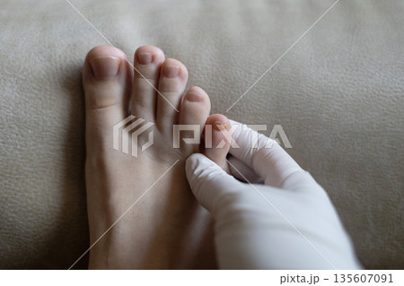 Close-up of damaged human nails showing discoloration, thickening, and separation. Concept of onycholysis, onychomycosis, hyperkeratosis, nail fungus, chromonychia, fungal infection 135607091